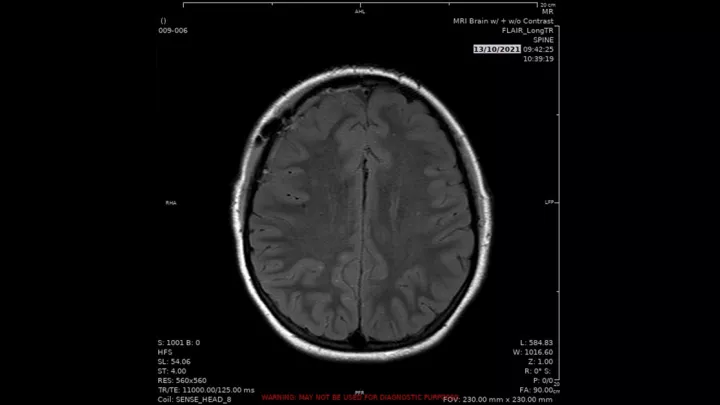 MRI brain scan