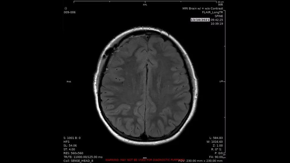MRI brain scan