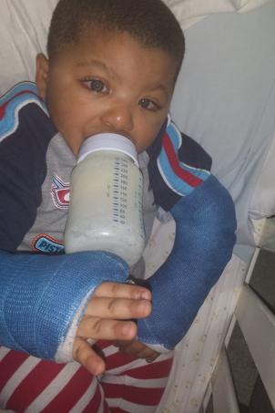 A toddler with casts on both arms drinks from a bottle of milk he is holding.